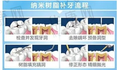 树脂充填术