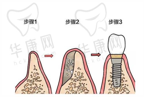 美国3种种植体