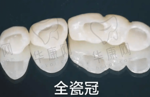 南阳植得口腔爱尔创全瓷冠1099元起，适合镶牙/牙缺失/根管