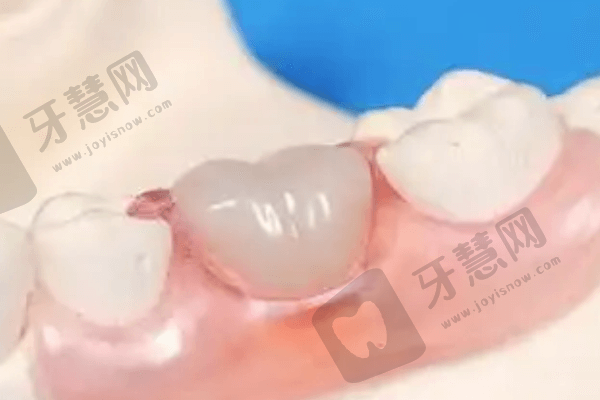 深圳同步口腔树脂补牙怎么样？