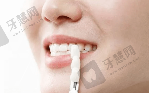 深圳美莱口腔超薄贴面优势有哪些？