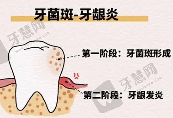 牙龈炎症状的表现是什么？