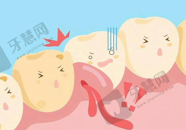 牙龈炎怎么治疗？