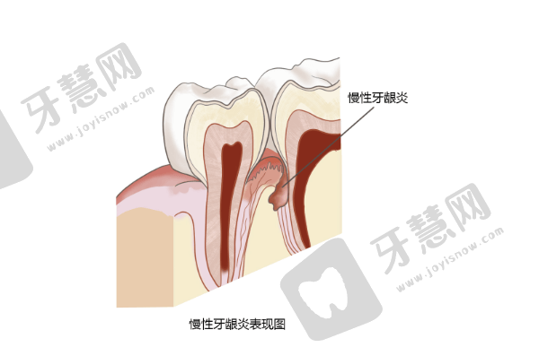 牙龈炎怎么治才能根除？