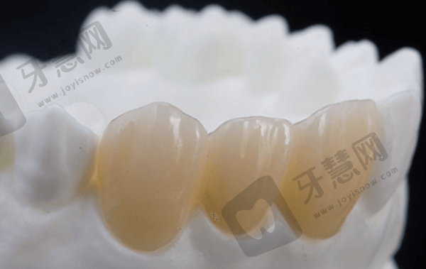 全瓷冠修复后该如何护理？