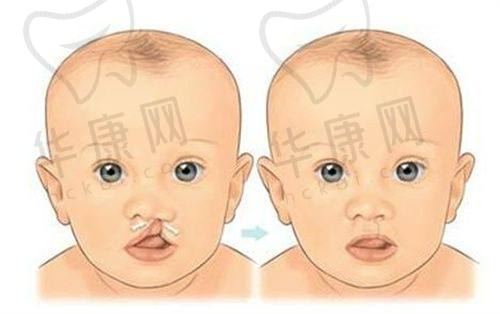 贵阳利美康医院孔令杰腰腹吸脂4980元起，精细雕琢打造自然紧致腰腹线条！