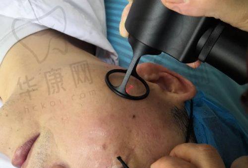 广州紫馨整形外科医院李希军做鼻部整形真的好，术后自然挺翘宛如天生美鼻！