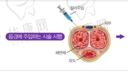 杭州艺星欧阳帆医生做双眼皮的亮点
