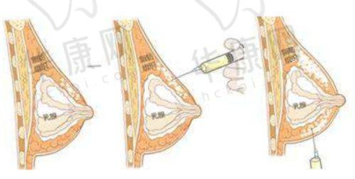 总结：贵阳利美康医院孔令杰腰腹吸脂4980元起的优势与价值