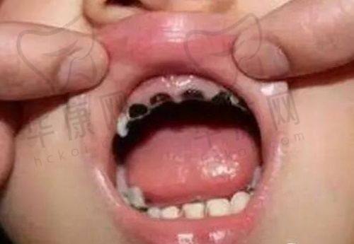 种植牙手术真人实例成效怎样？