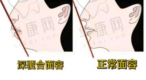 上海曹杨众植口腔全口吸附性义齿真实经历：从“食之无味”到“大快朵颐”