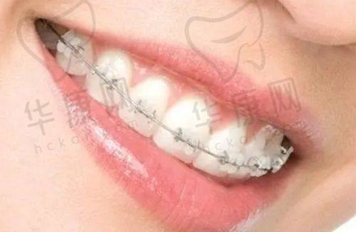记录在福州台江科尔口腔做牙齿矫正全过程：虎牙、天包地等问题统统搞定！