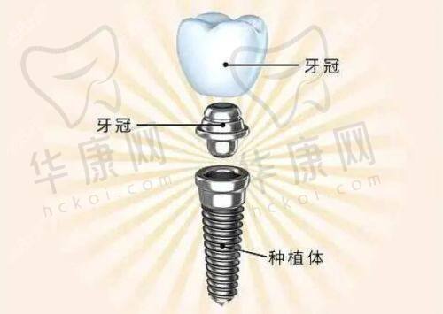 选择北京约康口腔时代天使隐形矫正的建议