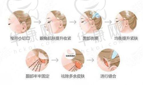 北京蒂凡妮郭建玲眼部整形19800元起，精细美容技艺打造灵动自然双眸