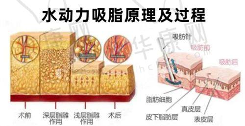 馒化修复手术过程