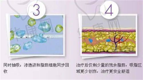 如何选择适合自己的鼻小柱延长材料？