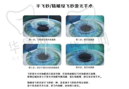 全飞秒与半飞秒手术过程区别