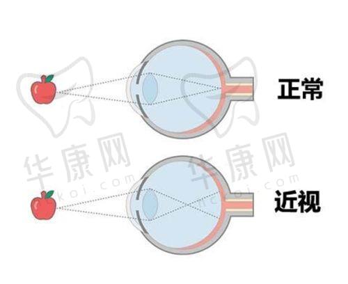 石家庄联谊眼科医院阿尔法角膜塑形镜的成功实例