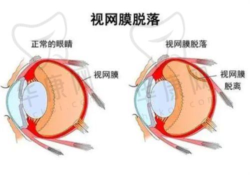 哪些近视人群适合个性化飞秒激光手术？