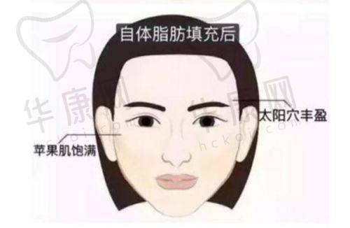 上睑凹陷填充脂肪后的美学成效与注意事项
