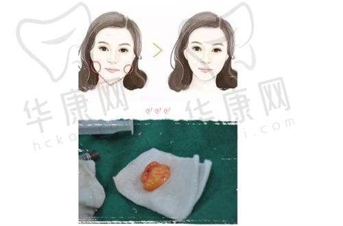 夏建军隆胸的价格与性价比