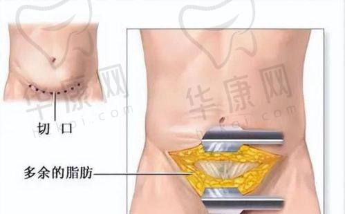 广州紫馨展望医生腹壁整形59800元起，3级医院案例多技术优效果赞