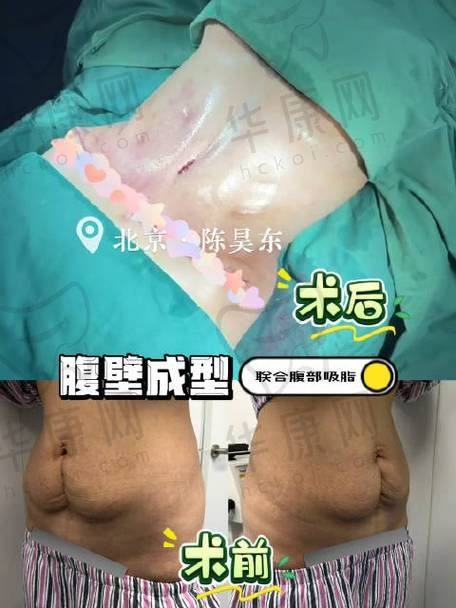 展望医生腹壁整形的预约方式