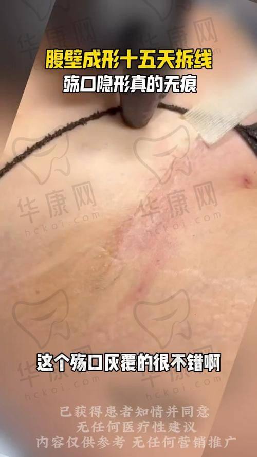 广州紫馨展望医生腹壁整形实例分享