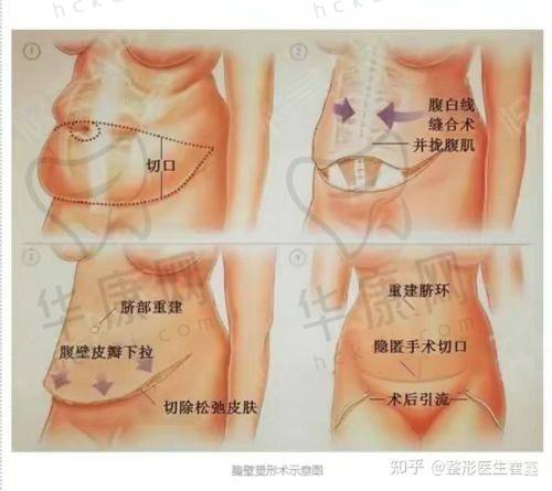 宝妈选择展望医生腹壁整形的真实反馈