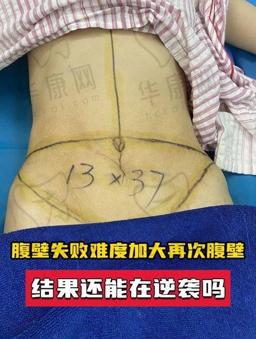 展望医生在腹壁整形方面的特色优势