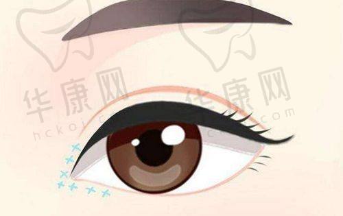 长沙美莱医疗美容医院文婷医生特色技术优势