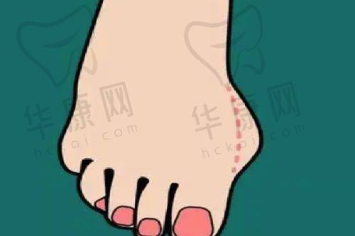 深圳悦尔医疗美容门诊部疤痕科手术细节