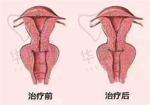 武汉五洲整形外科医院乳房悬吊有何特色?