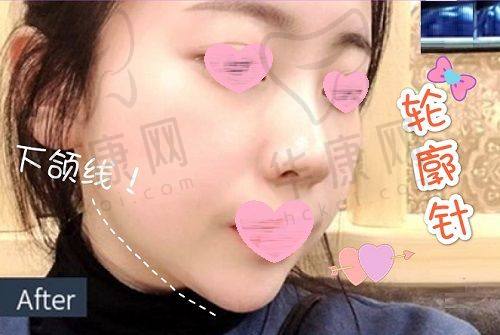 南宁华美医疗美容医院卢志刚医生预约方式