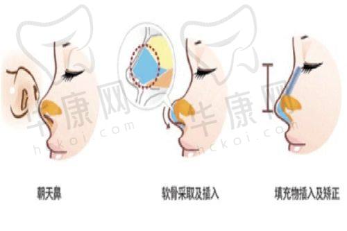 选择武汉五洲杨水斌半肋鼻综合的理由