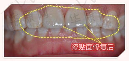 深圳启正口腔爱尔创全瓷牙的售后保护