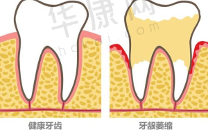 凸嘴矫正的治疗成效