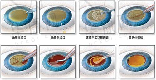 合肥沃瑞眼科医院在蔡司三焦点人工晶体项目上的特色优势