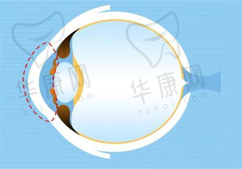 安顺光明眼科医院个性化飞秒近视手术的技术保护
