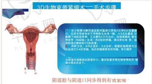 手术：安心舒适的体验