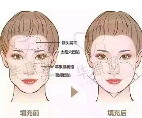 总结：马行医生，吸脂的理想之选