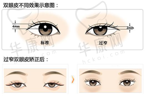 严格并发症预防措施