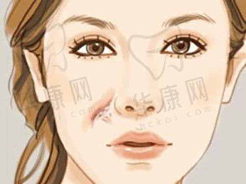 武汉五洲杨水斌半肋鼻综合25770元起，原生美学塑造自然挺翘美鼻！