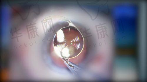 无锡新视界眼科医院患者口碑