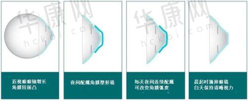 潍坊明润眼科医院擅长ICL晶体植入术的医生优势