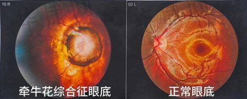 成都双楠医院眼科近视手术的费用情况