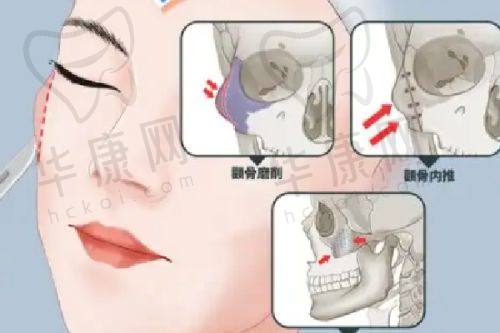 热拉提的安心性与后遗症情况