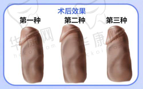 杭州天鑫医疗美容医院艾长安自体脂肪隆胸真实实例