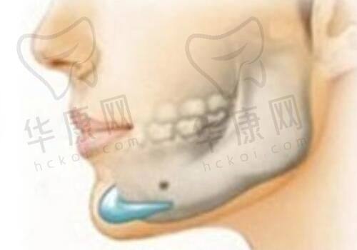 生活方式怎样影响3D生物束带缩阴成效的持久性?