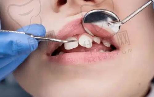 与其他口腔医院全口牙周治疗的对比